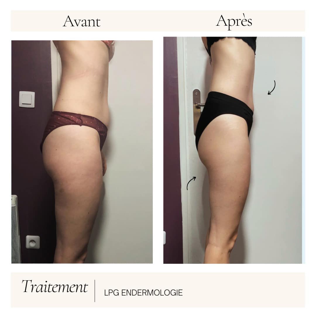 traiement-lpg-endermologie-avant-apres