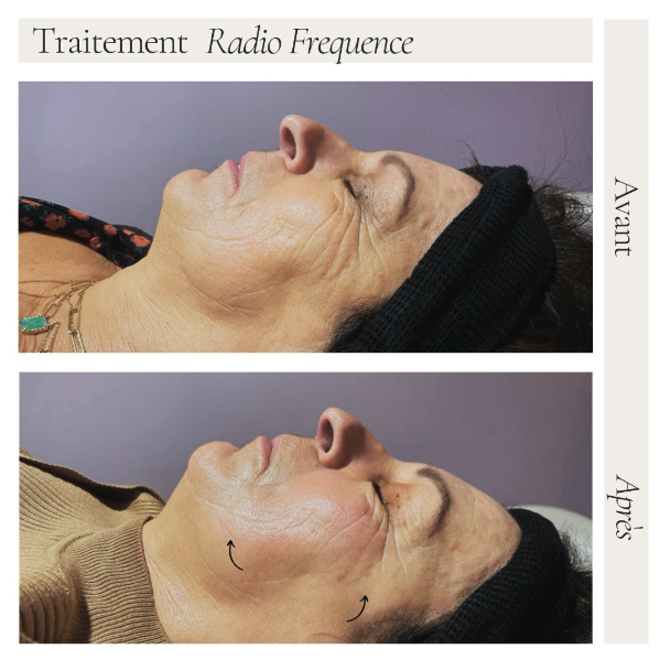 radiofrequence