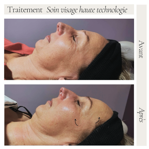 soin-visage-haute-technologie
